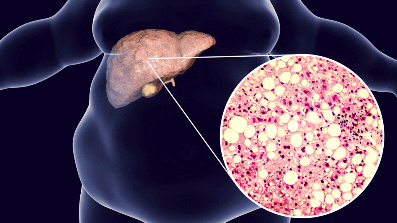 Hígado graso: el café podría ayudar a frenar la fibrosis hepática, según estudios científicos
