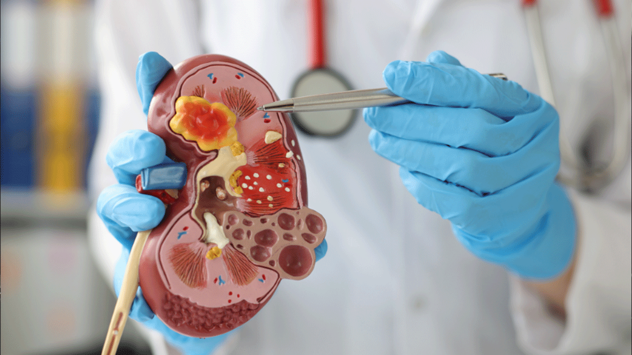 Enfermedad renal crónica avanza silenciosamente y preocupa a especialistas